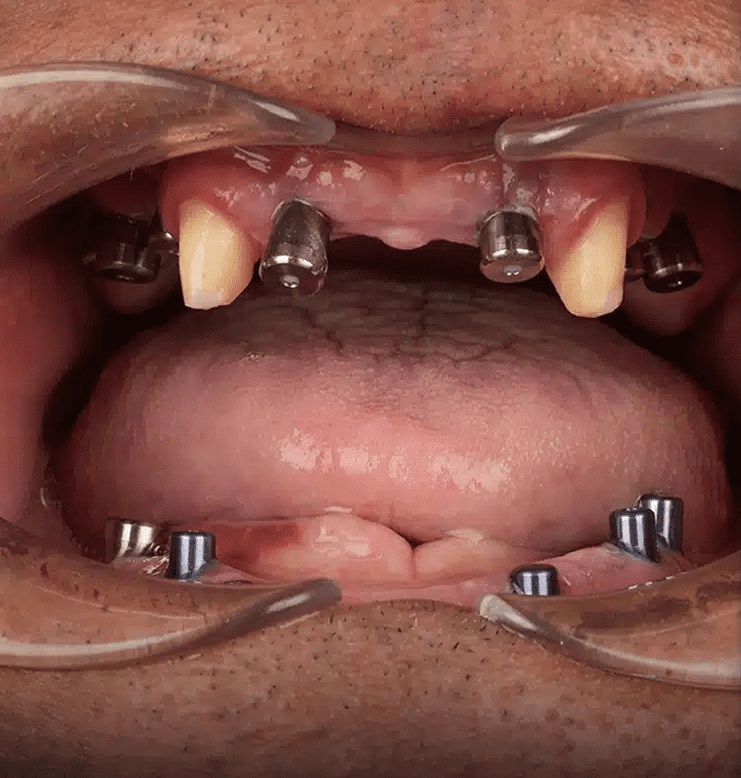 Inserare implanturi dentare